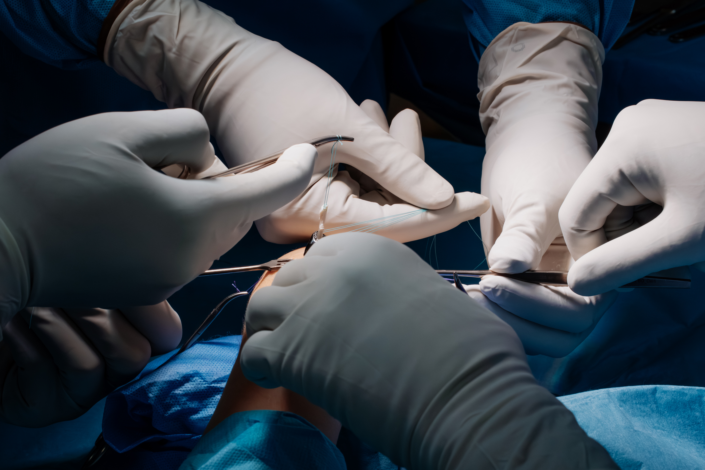 Skomplikowana operacja nadgarstka przy użyciu kości wydrukowanej w technologii 3D